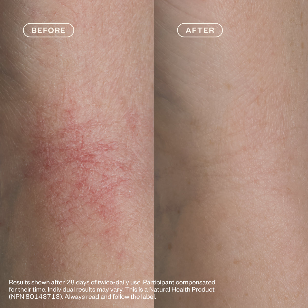 Eczema Cleanse & Comfort Ritual